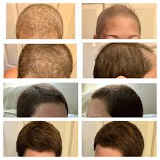 Whether you are a cancer patient researching tips & tricks to use to help your hair grow back after chemo, the victim of a bad haircut or simply want longer, stronger, healthier hair — i've got you covered! How To Promote Hair Regrowth After Chemo