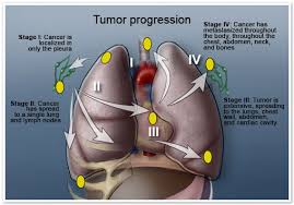 Perisik yang dinyalakan oleh mesothelioma pleura adalah effusi pleura neoplastik, dirasakan oleh pesakit sebagai sakit yang tidak normal di dada, yang menonjolkan batuk dan pernafasan mendalam. Mesothelioma Diagnosis Roswell Park Comprehensive Cancer Center