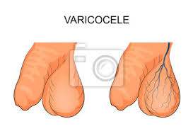 Nov 22, 2016 · eine varikozele ist eine erweiterung (krampfader) der venen in der haut des skrotums. Der Hoden Im Hodensack Varikozele Betroffen Fototapete Fototapeten Urologie Medicals Penis Myloview De