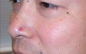 A spot that changes color. Skin Cancer Basal Squamous Cell Carcinoma Dermatology In Gulf Breeze Florida