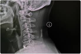 Check spelling or type a new query. Treatment For Cervical Spondylosis