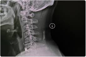 This is why any tip for neck decompression or fixing neck alignment is worth incorporating into any rec Treatment For Cervical Spondylosis
