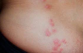 Image result for bedbugs bites