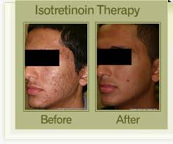 Acne Treatment Miami, Florida