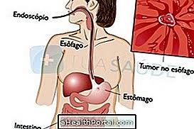 Kanser esofagus sering tidak didiagnosis sehingga mencapai tahap lanjut, jadi ketepatan dalam proses diagnosis dan pementasan sangat penting untuk hasil yang terbaik. Bagaimana Untuk Mengenal Pasti Dan Merawat Kanser Esofagus Gangguan Gastrousus