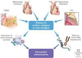 Allirgy upper resp.tract diseases cold. Pericarditis And Post Cardiac Injury Syndrome As A Sequelae Of Acute Myocardial Infarction Springerlink