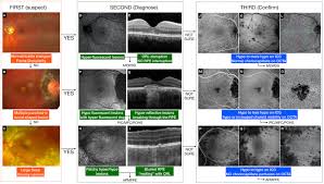 Stepwise approach for fundus imaging in the diagnosis and management of  posterior uveitis - Survey of Ophthalmology