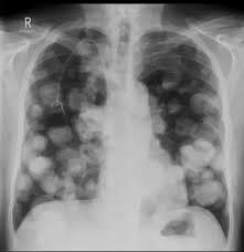 Like other cancers, breast cancer can invade and grow into the tissue surrounding the breast. How Can A Pa View Chest X Ray Detect Breast Tumors Quora