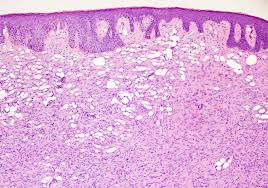 Image result for Dermatofibrosarcoma Protuberans