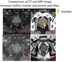 Only 1 patient has developed a urinary tract infection requiring additional antibiotic … Influence Of Fiducial Marker For Mr Image Of Prostate Radiotherapy