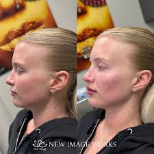 Chicago LIPS•FILLER•BOTOX•PRF