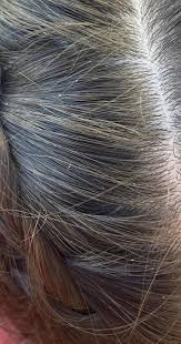 Image result for lice vs dandruff