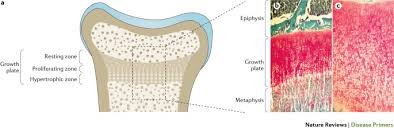 Image result for Rickets