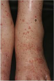 Senile purpura is a condition that impacts the elderly and is referred to in many different ways. Leukocytoclastic Vasculitis With Purpura And Renal Failure Induced By The Anti Epidermal Growth Factor Receptor Antibody Panitumumab A Case Report Journal Of Medical Case Reports Full Text