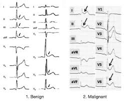 Image result for Early Repolarization