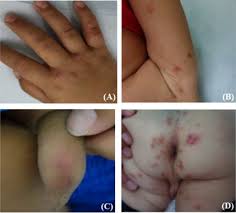 Image result for scabies human children