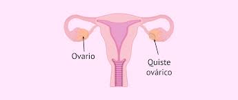 Que Son Los Quistes Ovaricos Tipos Sintomas Y Tratamiento