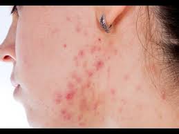 We did not find results for: How To Stop Hormonal Acne Hormonal Acne Treatment Youtube