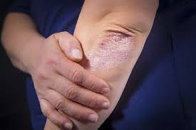 Resultado de imagen para imagenes de dermatitis en codos de humanos