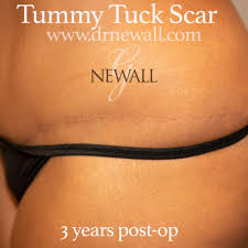 Belly button surgery can be performed under local anesthesia. Tummy Tuck Houston Tx Sugar Land Abdominoplasty