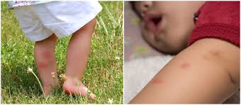 Așadar, o mușcătură de păianjen poate apărea ca o mică inflamație roșie sau, în cazuri mai grave, ca o leziune cutanată, cu aspect de hematom. Ce Trebuie Sa Faci Daca Copilul A Fost Intepat De Insecte Demamici Ro