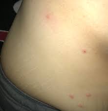 The bites usually go unnoticed until itchy, red marks develop that. What Could Be Causing These Itchy Bumps On My Wife S Back And Side No Stress Doesn T Look Like Hives Or Mosquito Bites Checked Bed For Bed Bugs Nothing Started Out With 3