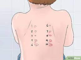 3 Ways To Treat Hives In Children Wikihow Mom