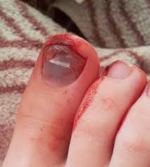 <blutergusses, blutergüsse> der bluterguss subst hämatom eine stelle, an der sich z. Hamatom Wikipedia