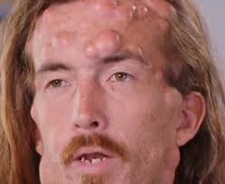 Dr Pimple Popper: Man with 400 tumours explains Gardner's syndrome