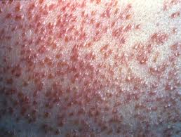 Tuberculosis cutis orificialis (also known as acute tuberculous ulcer 1 ) is a form of cutaneous tuberculosis that occurs at the mucocutaneous borders of the nose, mouth, anus, urinary meatus. Cutaneous Tuberculosis Dermnet Nz