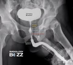 Image result for Retrograde Urethrogram