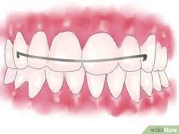 Generally, the treatment period takes from one year to two years. 5 Ways To Fix Crooked Teeth Wikihow