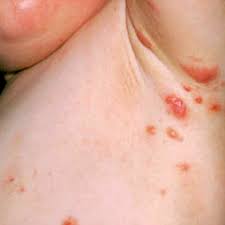 Image result for scabies human children