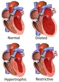 Heart muscle inflammation, swelling peak twice after heart attack. sciencedaily. Cardiomyopathy Wikipedia