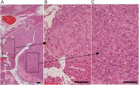Maybe you would like to learn more about one of these? Possible Reversibility Between Epithelioid And Sarcomatoid Types Of Mesothelioma Is Independent Of Erc Mesothelin Expression Respiratory Research Full Text