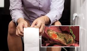 In some cases, even small tumors may press on the duct, enabling doctors to find the cancer at an earlier stage. Pancreatic Cancer Symptoms Signs Include Grey Colour And Oily Poo Express Co Uk