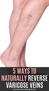 Pin On Home Natural Remedies