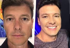 Com seus 44 anos de idade, já era esperado que as famosas 'entradinhas' começassem a aparecer. Rodrigo Faro Passa Por Procedimento Estetico Resultado Causa Espanto E Imagem Impressionante Vaza Tv Foco