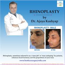 Nose Job Procedure Or Rhinoplasty That Reshapes And Balances The Nose Read About Costs Recovery Rhinoplasty Rhinoplasty Nose Jobs Nose Job Cost Rhinoplasty