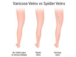 Check spelling or type a new query. Varicose Veins Vs Spider Veins Core Medical Wellness