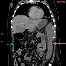 Image result for Neutropenic Colitis
