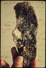 Coalworker S Pneumoconiosis Wikipedia
