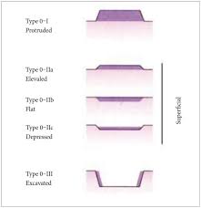 Prevention Strategies for Gastric Cancer: A Global Perspective