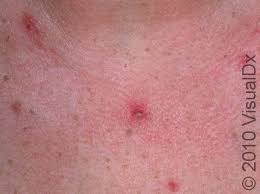 Image result for Pemphigus