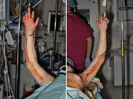 Escharotomy simply means opening the eschar. Management Of Burn Patients Plastic Surgery Key