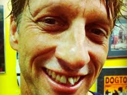 Tony Hawk casi pierde un diente por accidente