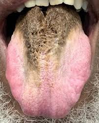Image result for black tongue symptoms