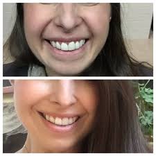 Mar 06, 2021 · regular injections of botox last about 5 months. For How Long Has Masseter Botox Ruined My Smile 4 Weeks 4 Months Or Forever What Went Wrong Photos