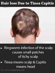 Hair loss is not a symptom of multiple sclerosis, however hair loss is a side effect of some ms medications or other commonly prescribed medications. Hair Loss Types And Treatments