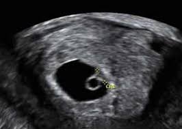 Heartbeat Bills And Call Them Fetal Pole Cardiac Activity Bills Dr
